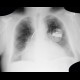 Congestive hepatopathy, biphasic flow in portal vein, heart failure, congestion: X-ray - Plain radiograph